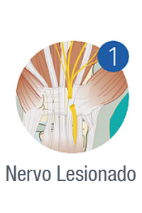 nervolesionado01