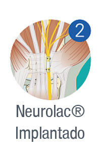 neurolac02-implantado